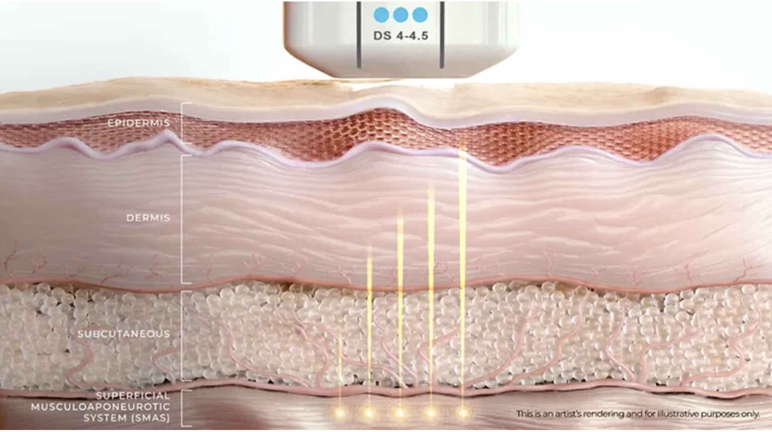 Ultherapy Prime technologie